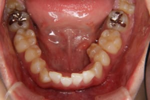 左下の第二小臼歯が舌側に転位しています
