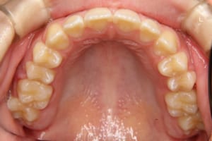 子供の矯正歯科治療後です