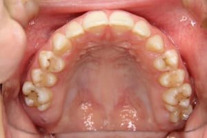 子供の矯正歯科治療後です