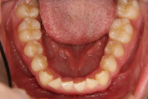 子供の矯正歯科治療後です