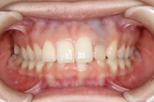 上顎前歯の突出、下顎前歯部の叢生、過蓋咬合が認められます。