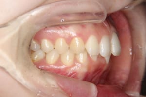 上顎前歯の突出、下顎前歯部の叢生があります。
