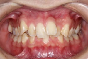 上顎前歯の突出、上下顎前歯部叢生、右下側切歯欠損