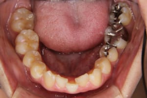 右下側切歯が先天的に欠損しています。