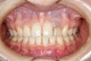 矯正歯科治療後です。円山さくらぎ矯正歯科にて治療。