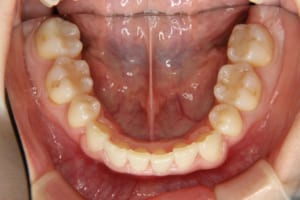 矯正歯科治療後です。左右第一小臼歯抜歯しています。