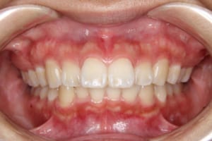 上顎の前歯の突出、下顎前歯の叢生があります。