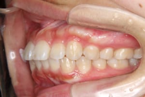 矯正歯科治療前の左側面です。