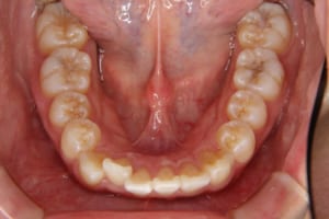 右下の側切歯が舌側に入っています。