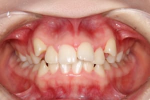 前歯部の叢生、八重歯、正中のずれがあります。