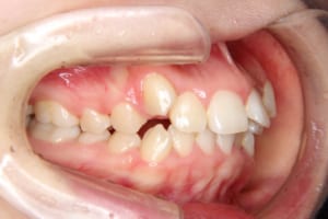 前歯部の叢生、八重歯があります。