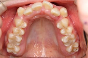 犬歯は唇側転位しています。