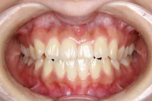 矯正歯科治療前。中切歯の被蓋が反対になっています。