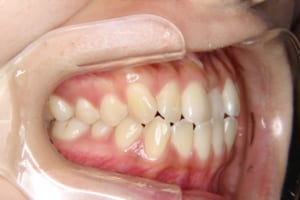 右上の中切歯は近心のみ逆被蓋です。