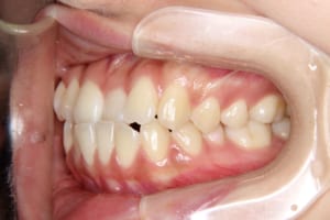 前歯部の叢生と中切歯の逆被蓋があります。