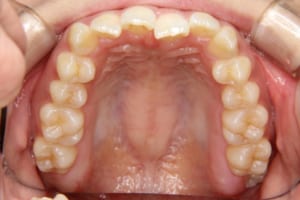 上の前歯が舌側傾斜しています。
