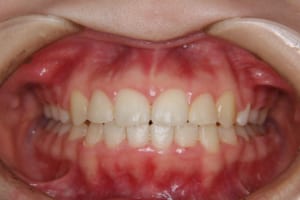 矯正歯科治療後です。叢生と八重歯は改善しています。