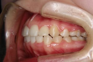 矯正歯科治療後の左側面です。