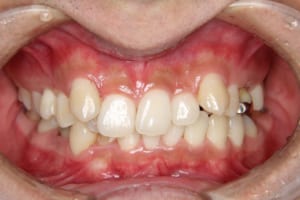 前歯部の叢生、過蓋咬合、正中のずれがあります。