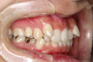 右下は第二小臼歯が欠損し、乳歯が残っています。