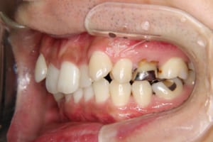 左上は第二小臼歯が欠損で乳歯が残っています。
