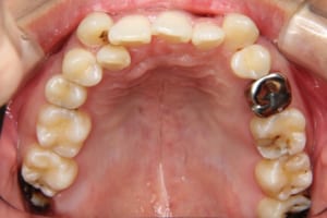 前歯部叢生。左上の第二小臼歯が欠損して乳歯が残っています。