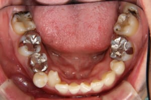 右下は第二小臼歯が欠損で乳歯が残っています。