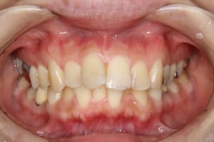 矯正歯科治療前です。前歯部叢生があります。