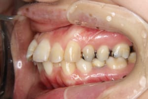 矯正歯科治療前です。前歯の突出と叢生があります。