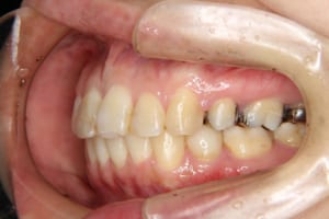 矯正歯科治療後の左側面です。円山さくらぎ矯正歯科。